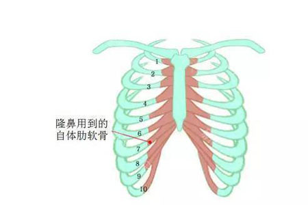 自体软骨隆鼻手术一般价格多少钱