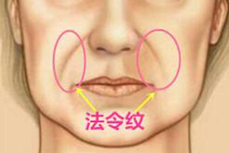 天生法令纹就很深要怎么去除啊
