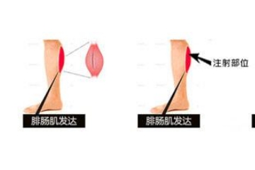 扎完瘦腿针可以跑步吗