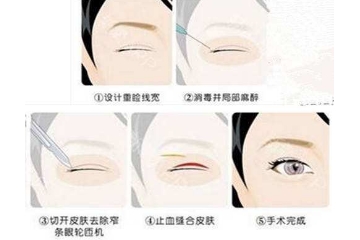 开眼角提肌多久能恢复自然