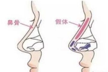 隆鼻手术多久恢复自然