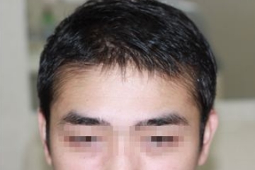 植发后头发还可以烫染吗？