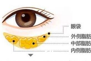 去除眼袋多少钱
