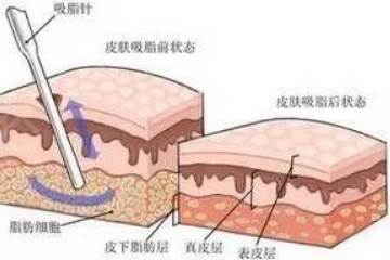 男生抽脂瘦身怎样