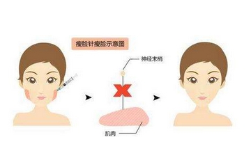 注射瘦脸多少钱呀