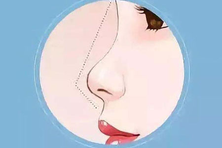 女生鼻头很肥大怎么办