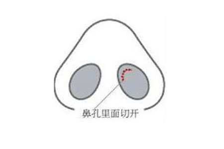 什么方法可以让鼻孔变小一点