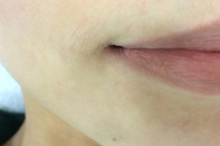 女生有点小胡子怎么办