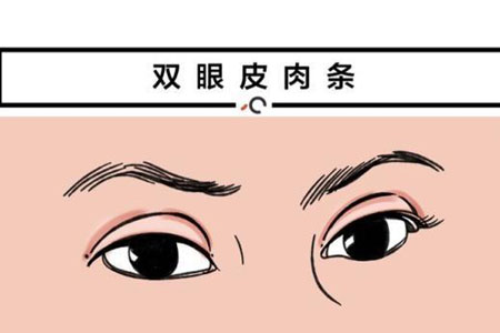 双眼皮手术失败了修复要多少钱