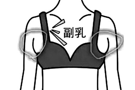 腋下长了副乳能去掉吗