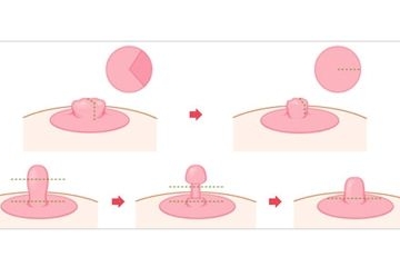 乳头大小不对称怎么办