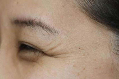怎样才能有效的去除眼角的鱼尾纹