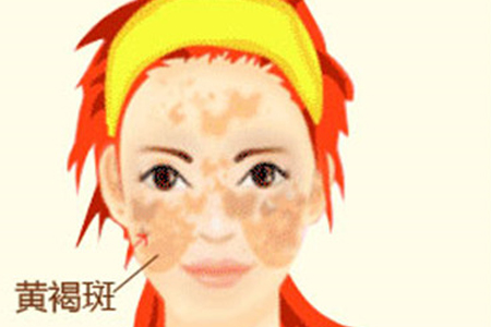 脸上长了很多黄褐斑怎么才能有效去除