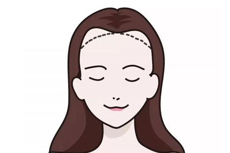 天生发际线就很高要怎么才能改善