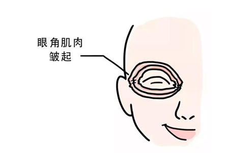 眼角的鱼尾纹很严重怎么办