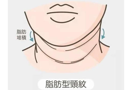 颈部出现了很深的颈纹怎么办