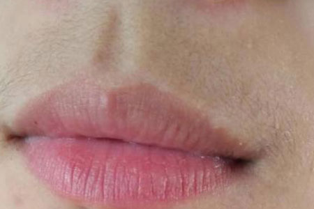 女生长胡子解决办法有哪些