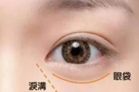 玻尿酸填泪沟需要多少钱