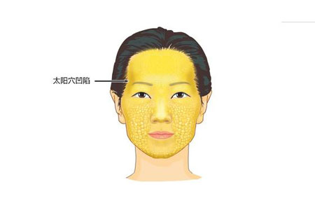 注射一只玻尿酸丰太阳穴多少钱