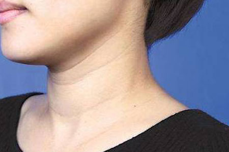 脖子上的颈纹打水光针可以消除吗