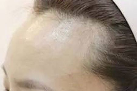 发际线调整做植发大概需要多少钱