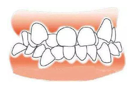 牙齿不整齐可以做美容冠矫正吗