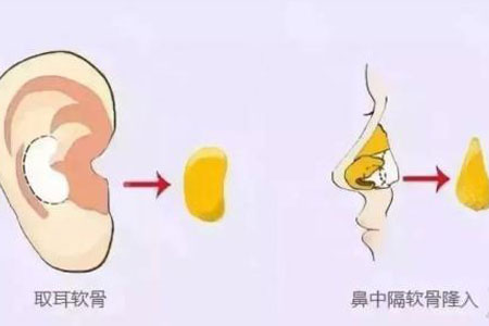 上海美莱做耳软骨隆鼻手术要多少钱