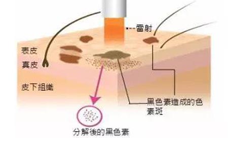 上海做皮秒激光去除黄褐斑多少钱