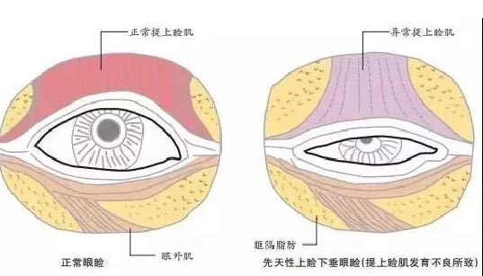 斜眼眼睑下垂怎么办