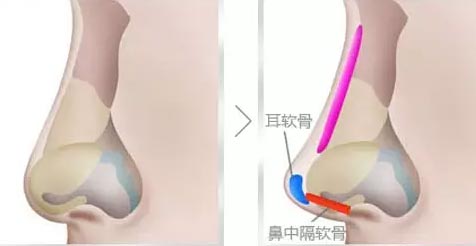 耳软骨隆鼻能保持多久