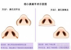 上海鼻翼缩小手术多少钱