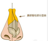 歪鼻矫正手术是怎么做的