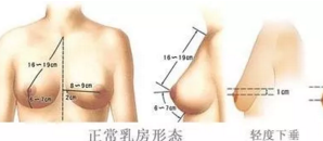 乳房下垂矫正一般多少钱
