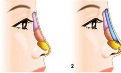 膨体隆鼻失败了怎么修复
