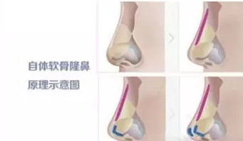 自体软骨隆鼻能保持终生吗