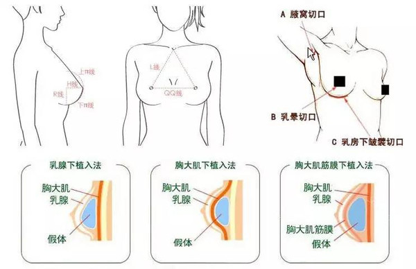 假体丰胸后遗症有哪些