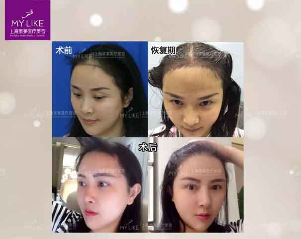 上海美莱植发际线真人案例
