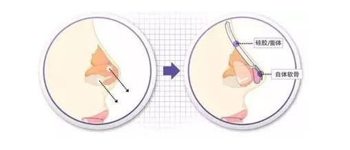 耳软骨垫鼻尖怎么样