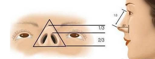 上海鼻孔外露怎么办，怎么缩小鼻孔