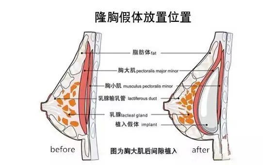 上海丰胸美容医院哪家做的好