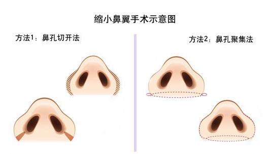 上海做缩小鼻翼手术是多少钱
