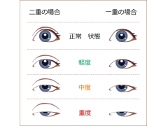上海眼睑下垂手术怎么做