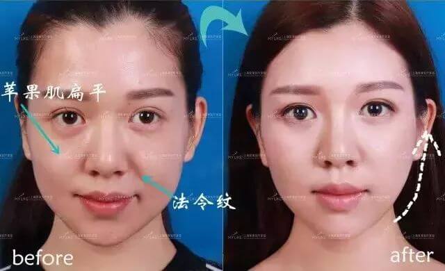上海美莱玻尿酸填充，让你拥有少女脸