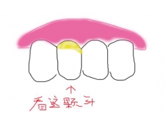 牙周病是什么原因导致的,怎么治疗