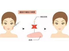 美莱瘦脸针都是什么品牌