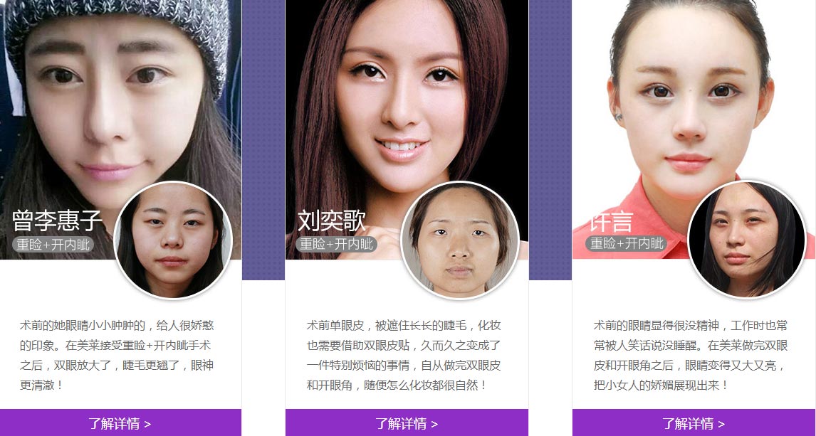 上海美莱开眼角前后对比照片图