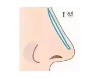 上海做完自体软骨隆鼻要注意什么