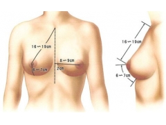 假体隆胸的注意事项我们需要注意哪些