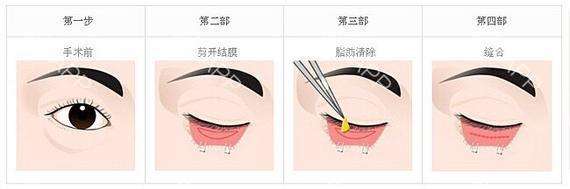 上海做去眼袋手术一般多少钱