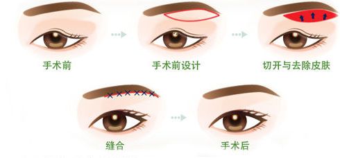 上海做眼皮下垂手术多少钱